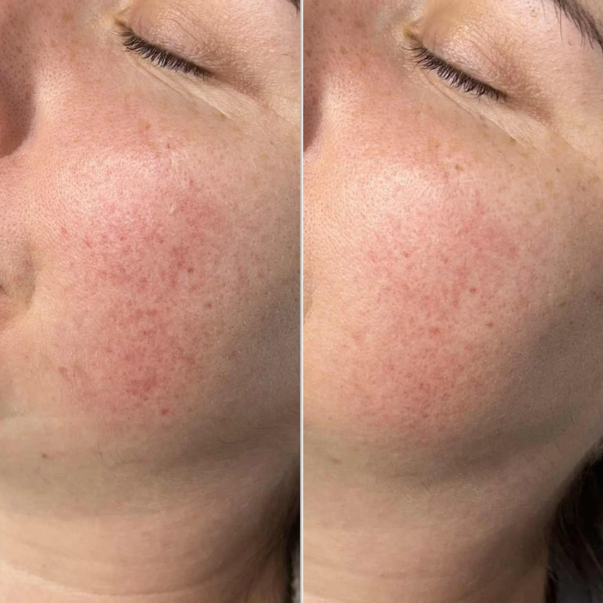Close-up of a person's cheek showing a before and after comparison of skin treatment, with reduced redness and clearer skin in the after image.