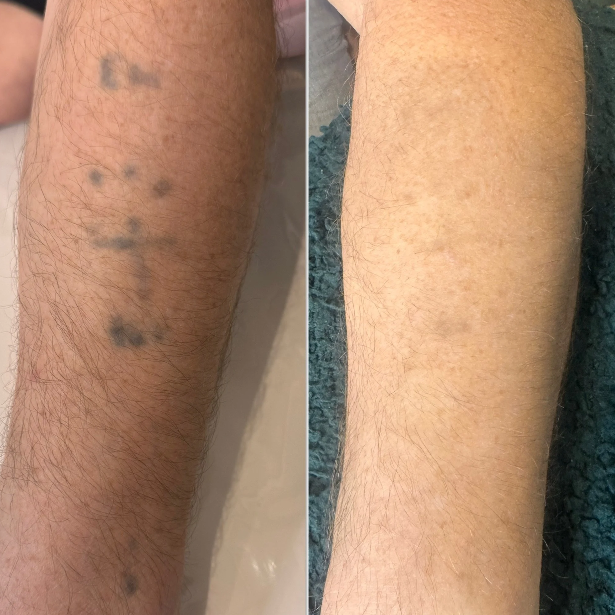 Comparison of a person's forearm before and after hair removal or skin treatment; the left side shows an arm with visible dark patches and hair, while the right side shows a smooth, hair-free arm.