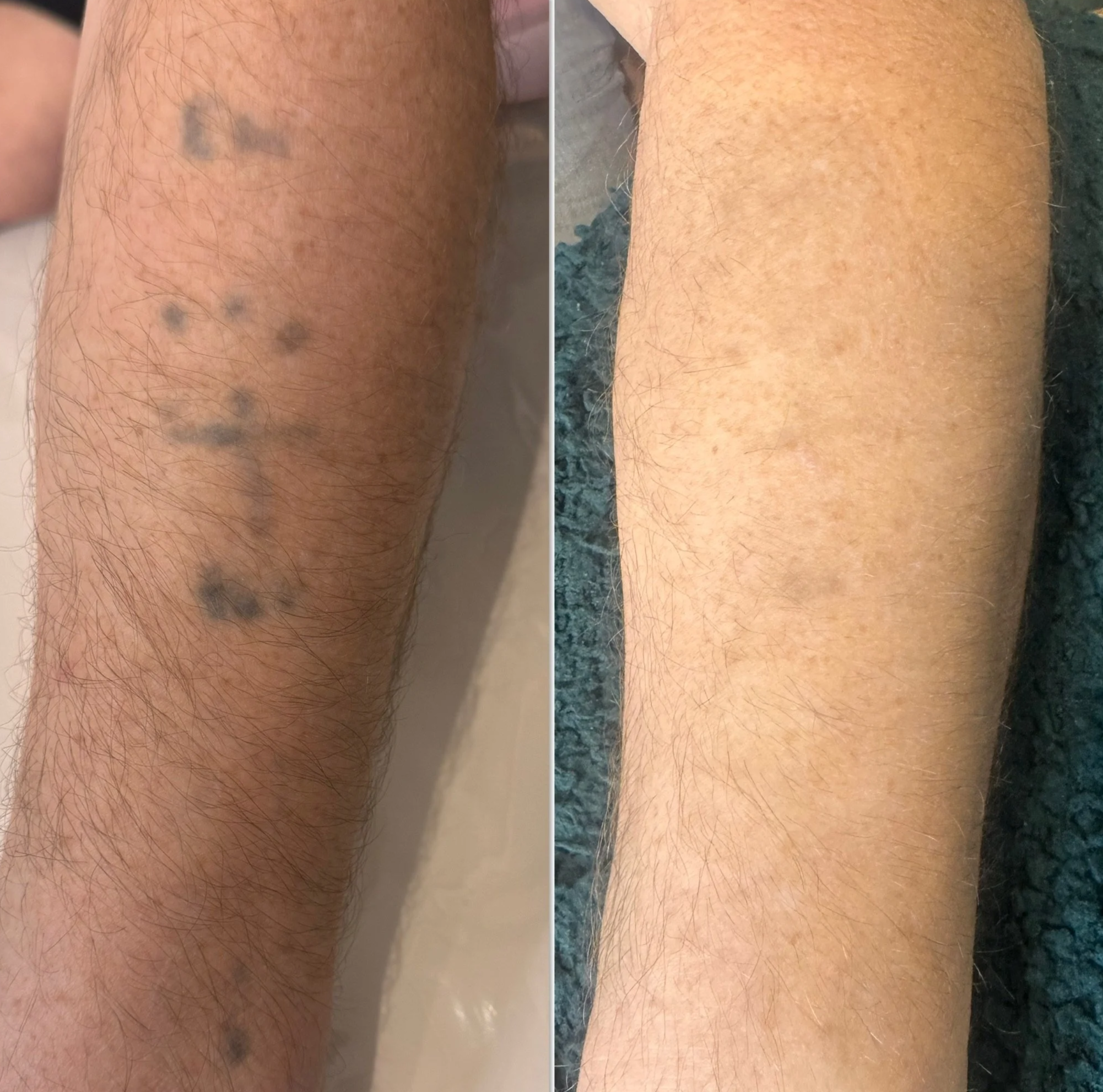 Comparison of a person's forearm showing removal of dark blue and purple tattoo ink.