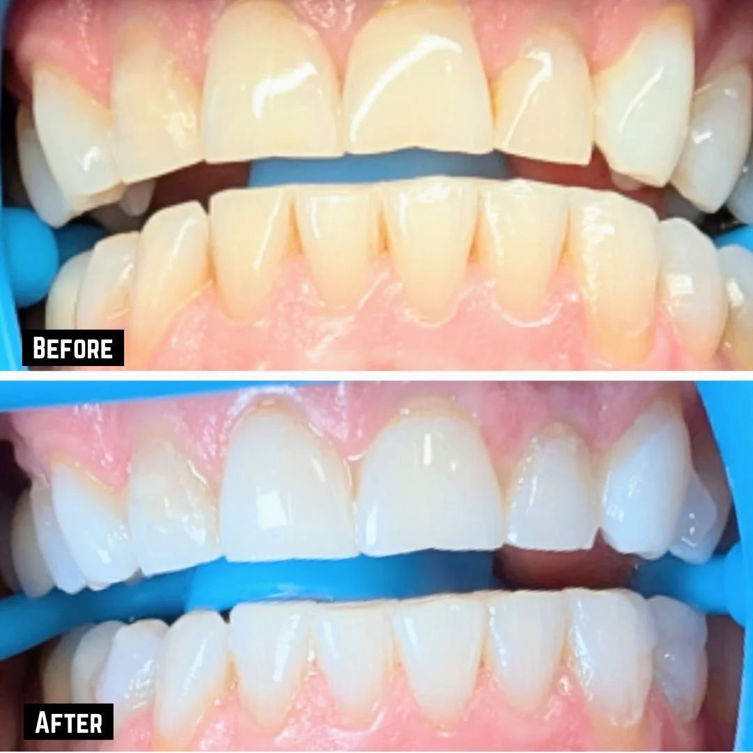 Before and After