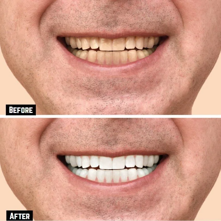 Before and After