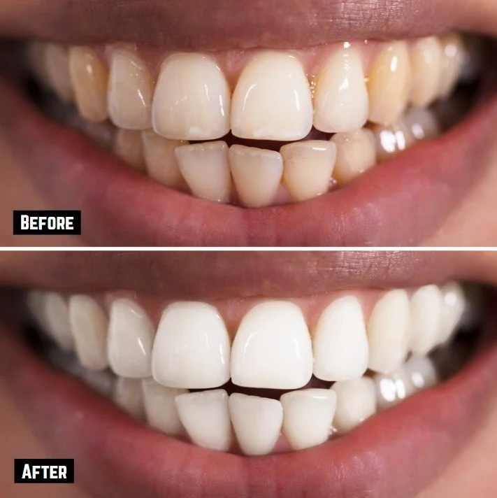 Before and After