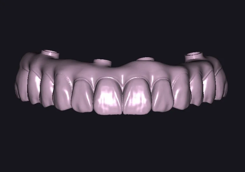 digital dental design services by Funes Dental lab