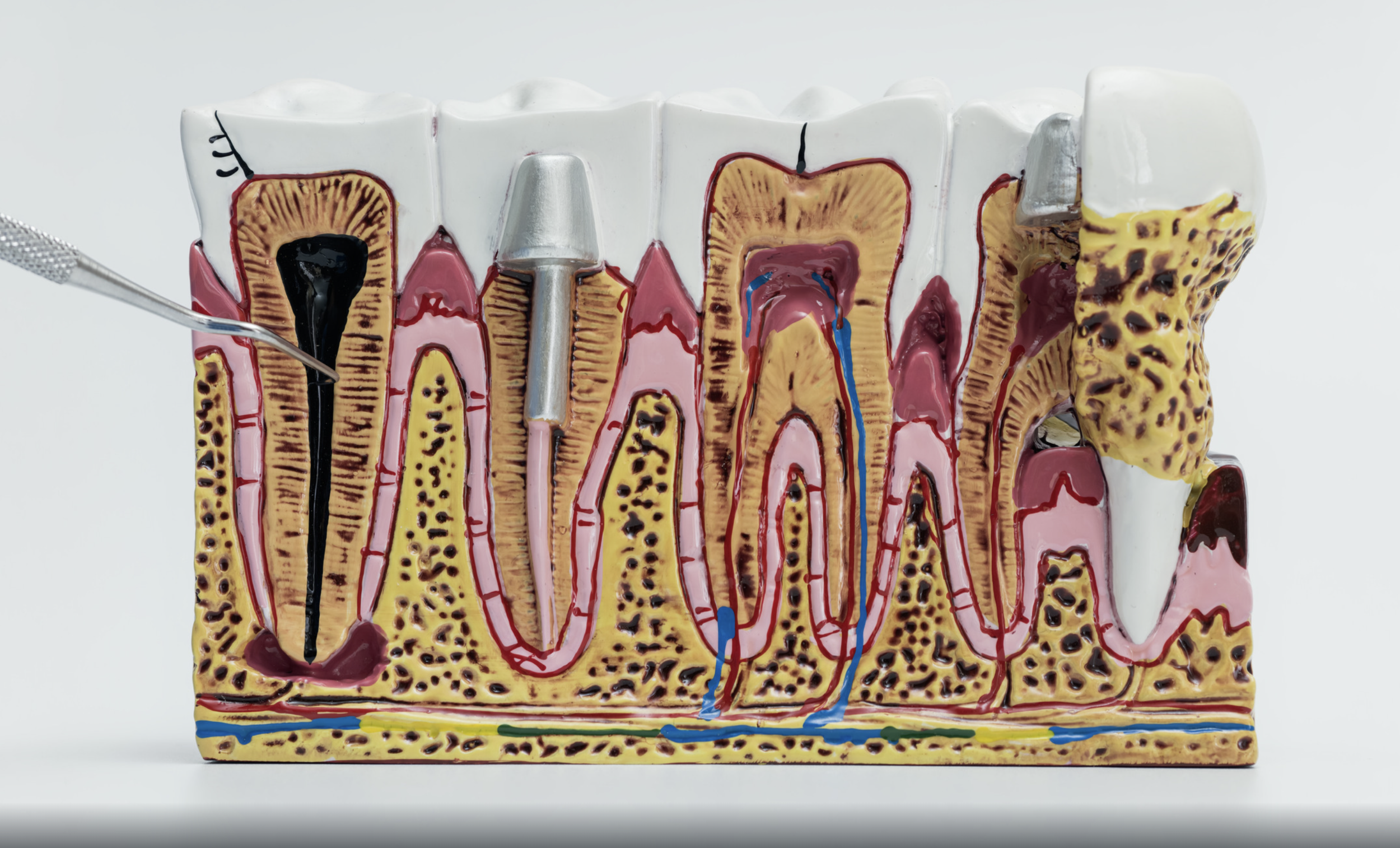 Endodonzia: Salvare il Dente dall’Interno