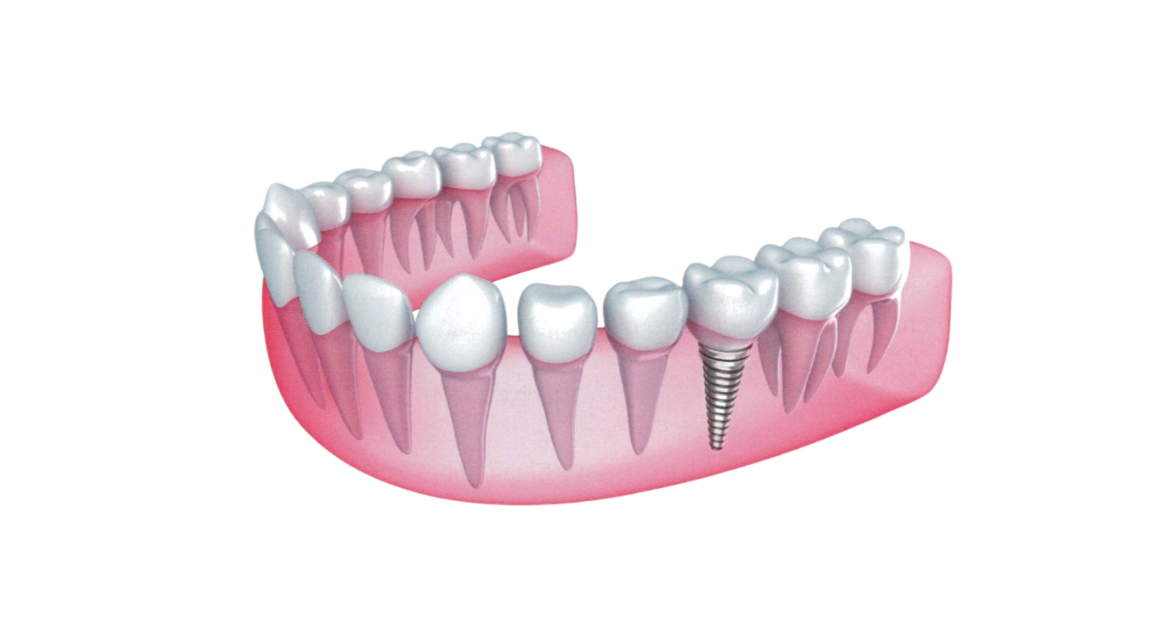 Che cos’è l’Implantologia Dentale?