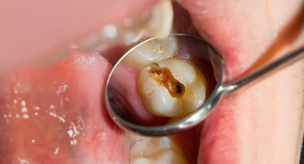 Odontoiatria Conservativa: Preservare il Dente e la sua Funzione Naturale