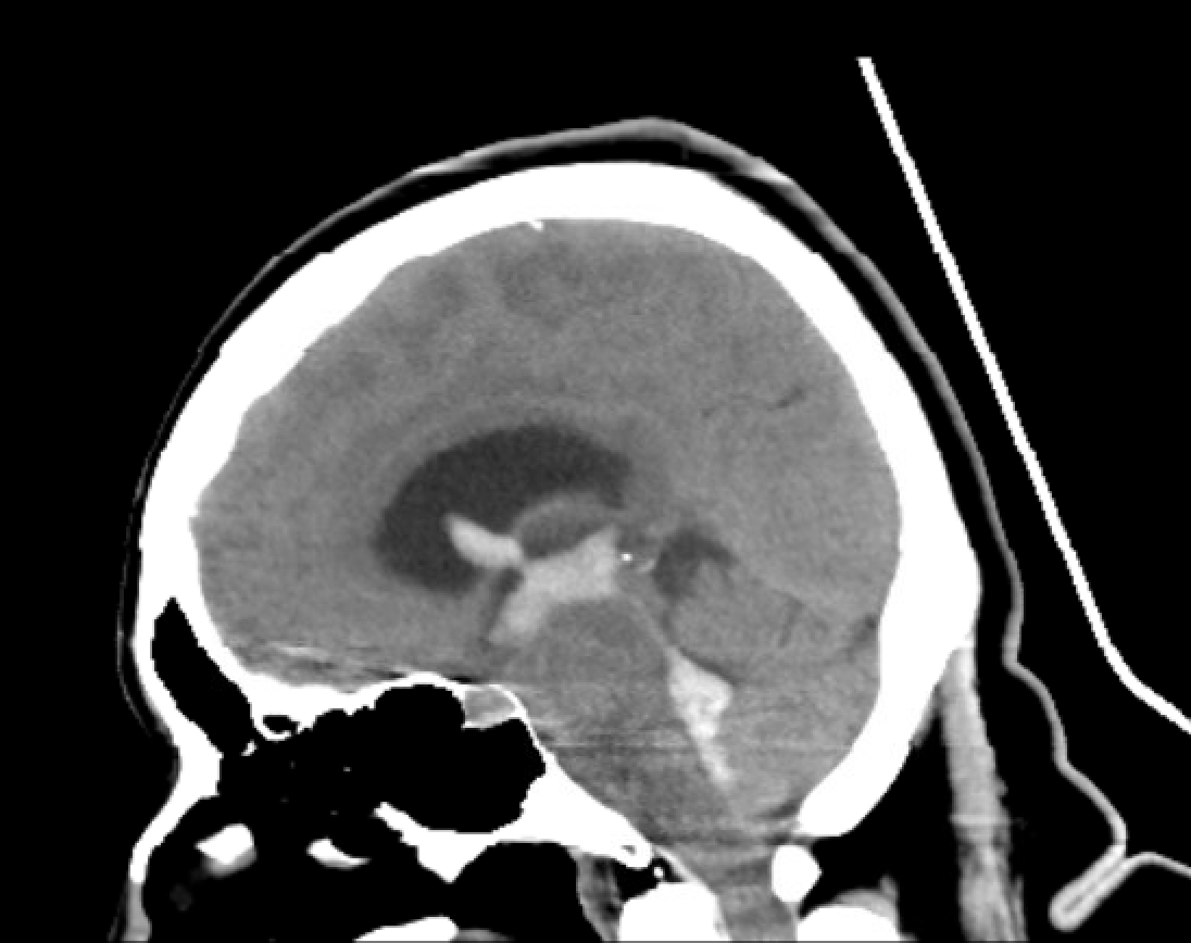 Intraventricular Hemorrhage