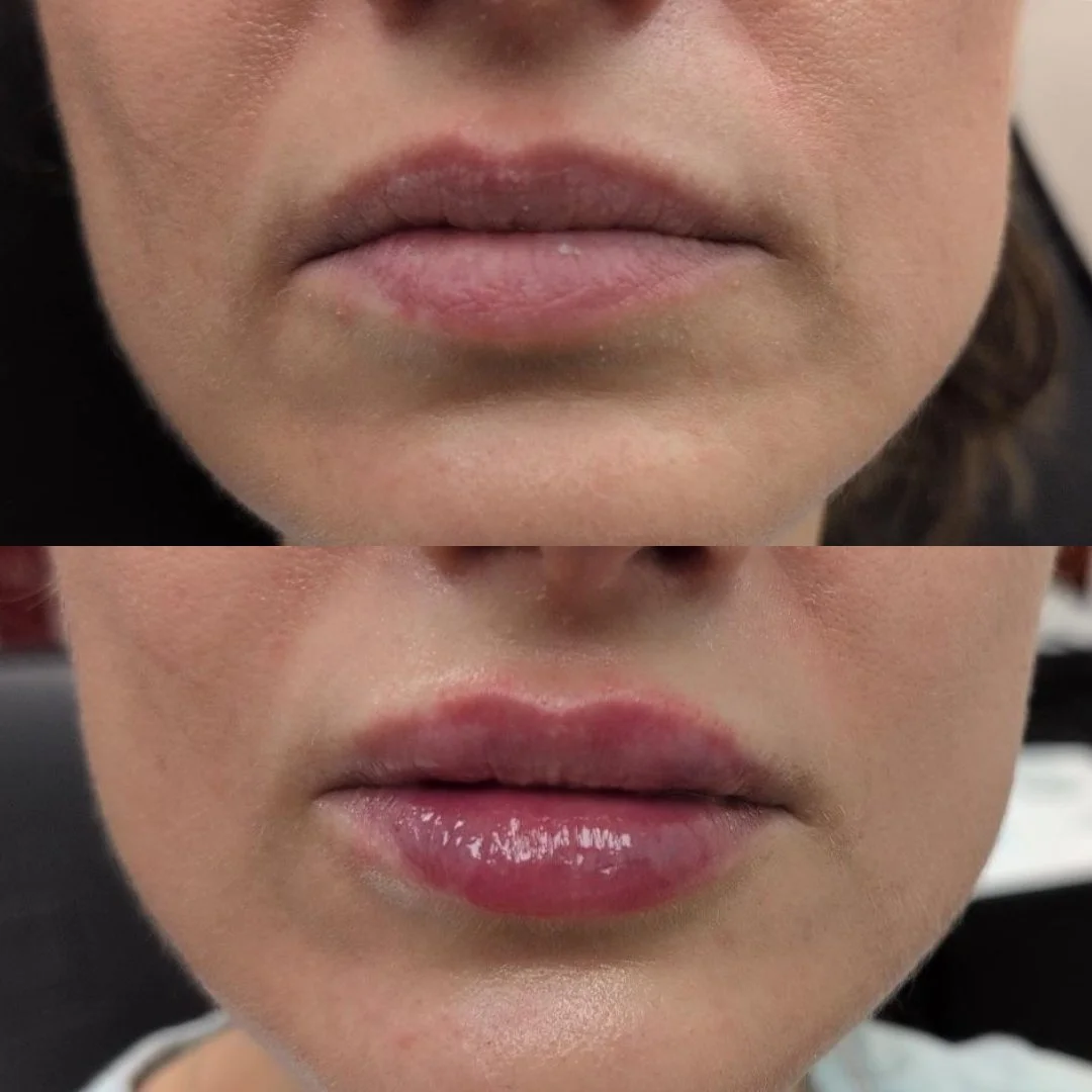 Lip filler before and after results at Bonato MD Aesthetics in Medford, OR