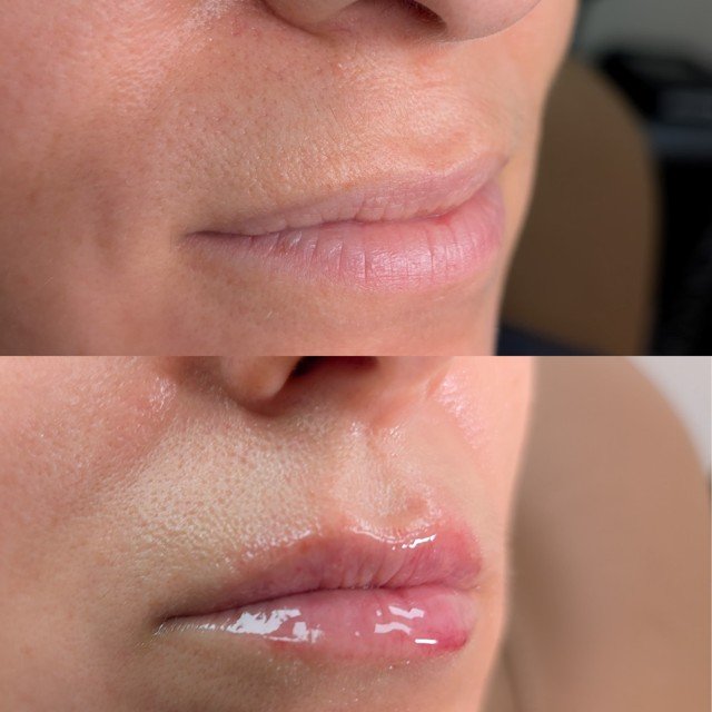 Lip filler before and after results at Bonato MD Aesthetics in Medford, OR