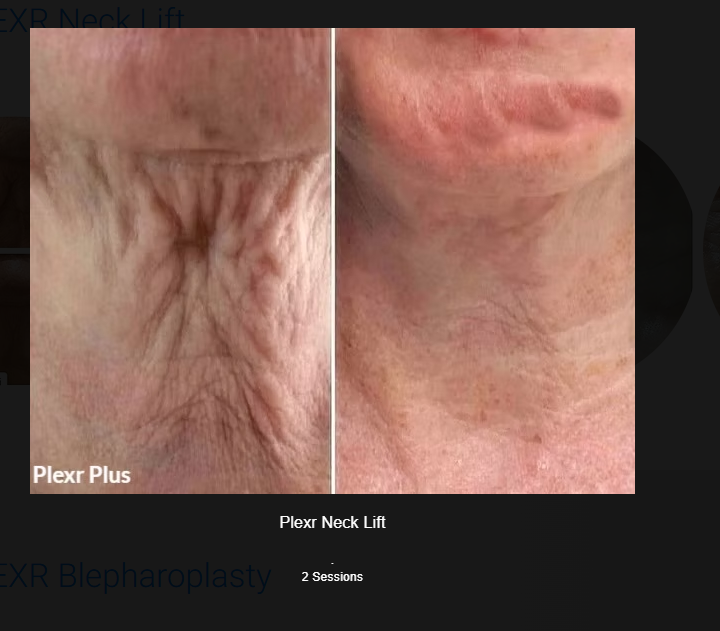 PLEXR Plus non-surgical neck lift before and after — Bonato MD Aesthetics