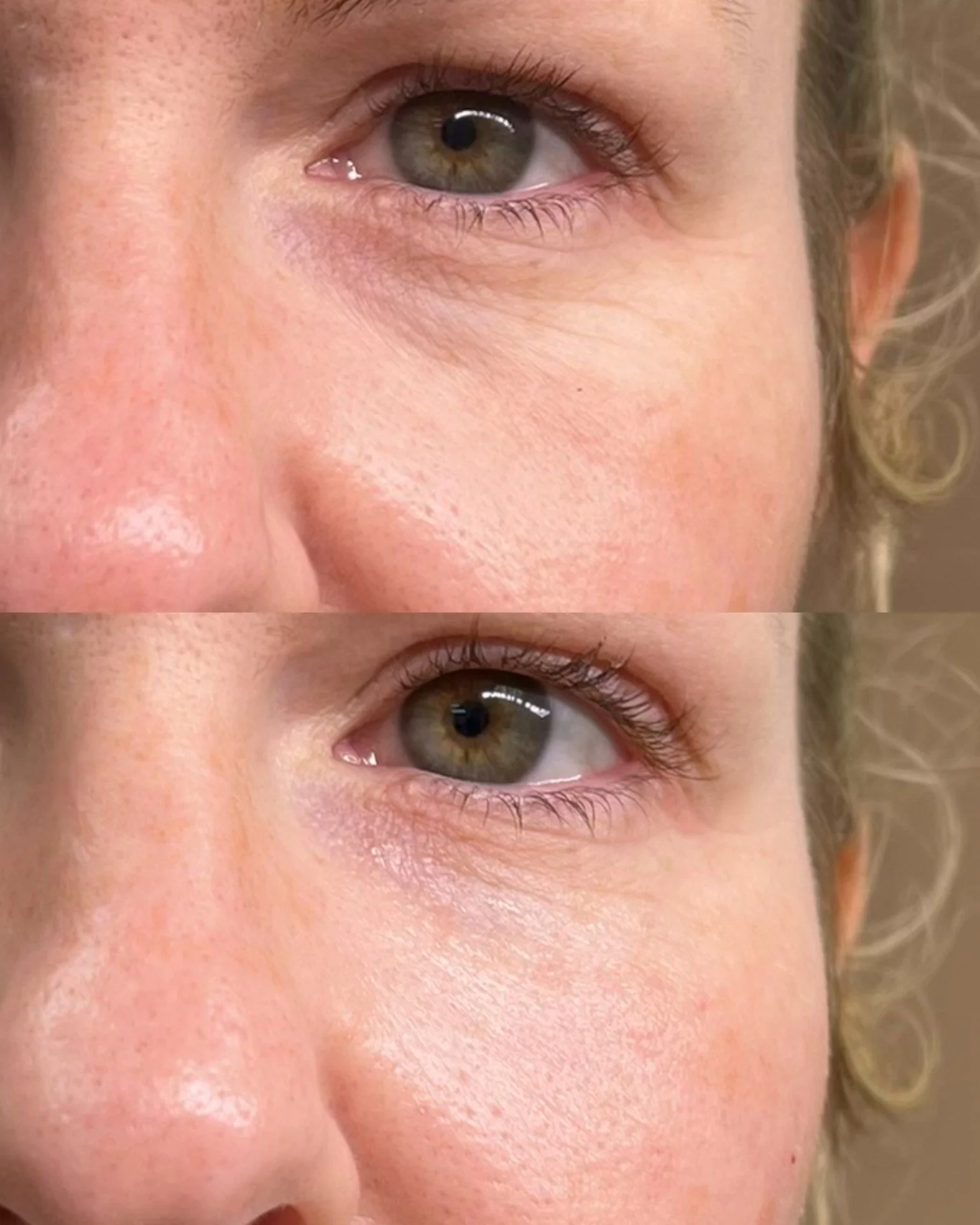 Cellenis Derma PRP gel filler before and after at Bonato MD Aesthetics in Medford, OR