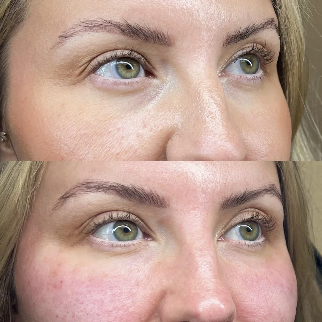 Cellenis Derma PRP gel filler before and after at Bonato MD Aesthetics in Medford, OR