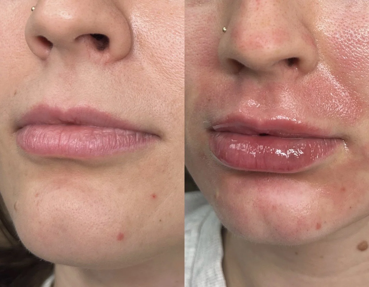 Lip filler before and after results at Bonato MD Aesthetics in Medford, OR