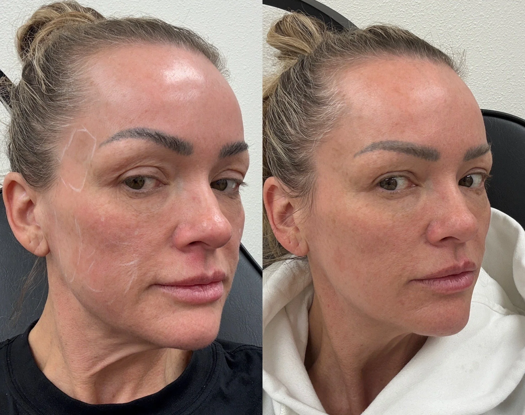 Sculptra biostimulator before and after results at Bonato MD Aesthetics in Medford, OR