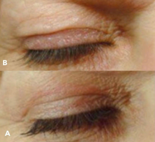 PLEXR Plus non-surgical eyelid lift before and after — Bonato MD Aesthetics