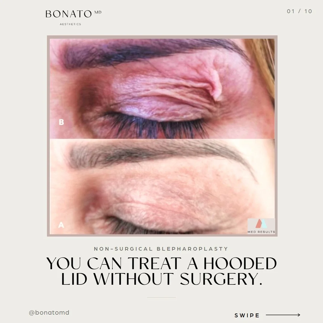 Ditch the scalpel, keep the lift. ✨

If your upper eyelids are starting to feel a bit heavier or rest on your lash line, you don&rsquo;t need an operating room to get a refreshed, bright-eyed look.

Our PLEXR Plus Plasma Blepharoplasty&mdash;often ca