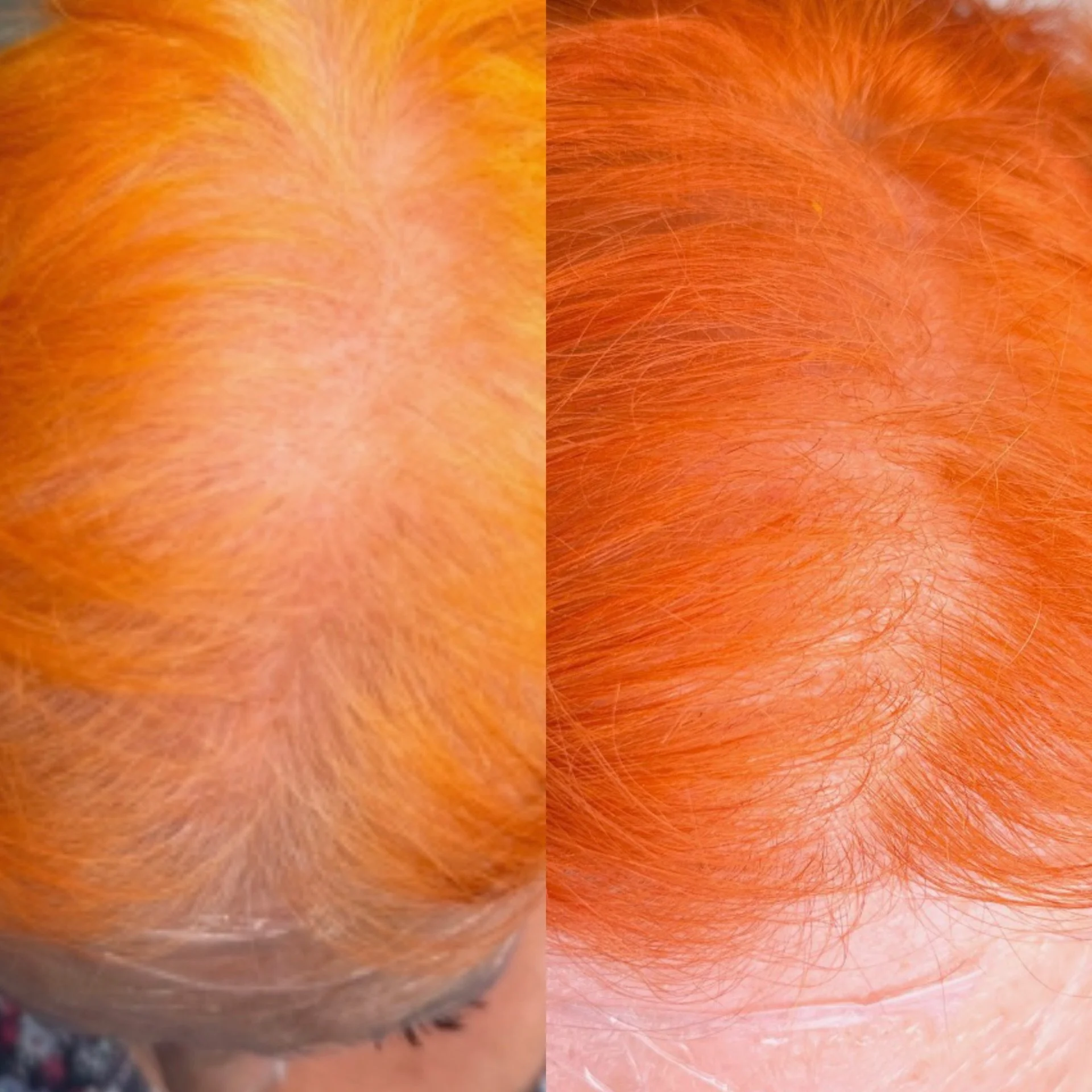 The before &amp; after speaks&mdash;but the data tells the real story.
In just 1.5 months, this patient&rsquo;s HairMetrix scan revealed:
&bull; 31% increase in overall hair coverage
&bull; Stronger, thicker individual strands
&bull; Active follicula