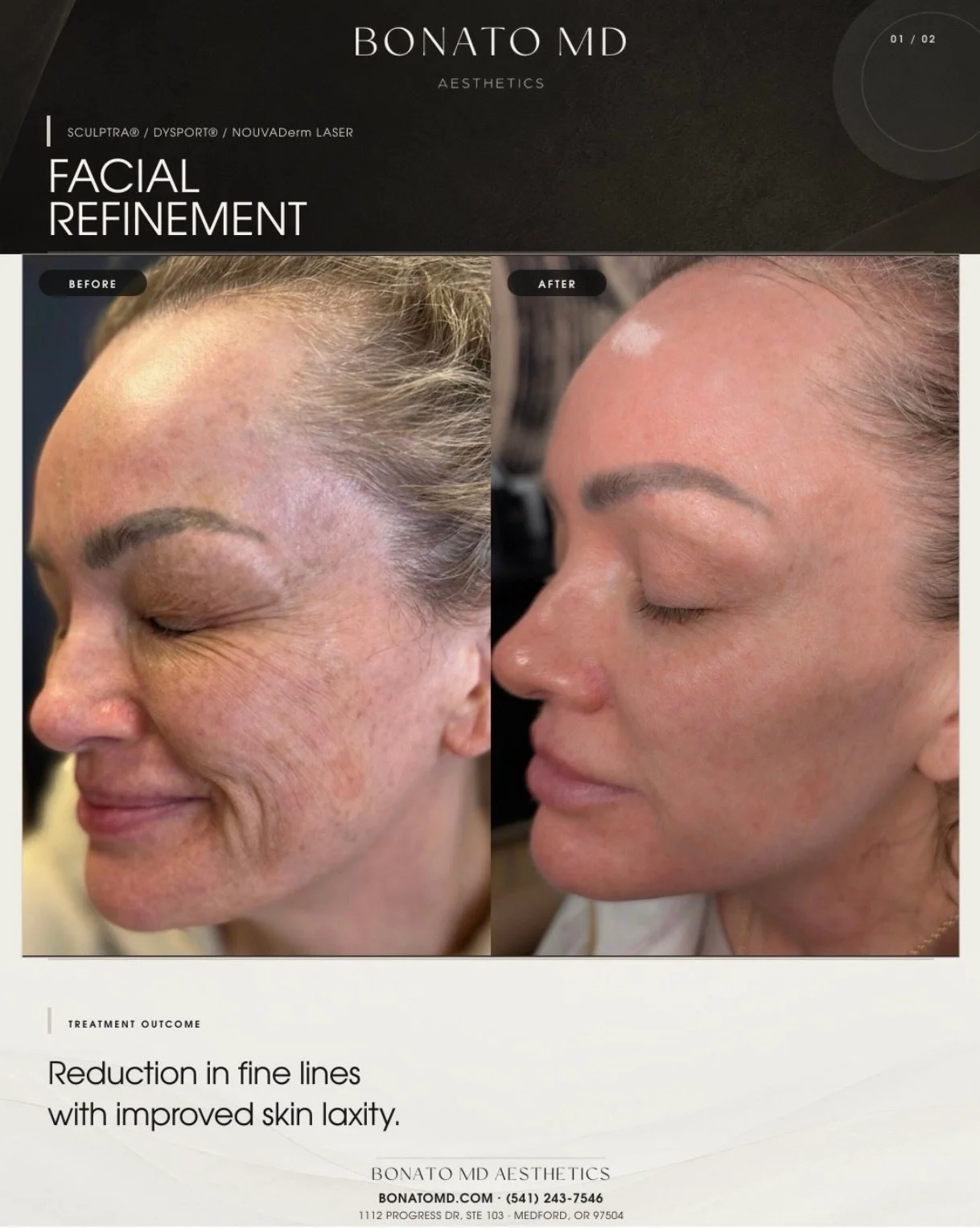 This is what a thoughtfully stacked treatment plan can achieve.

This transformation was not the result of one appointment&mdash;or one treatment. It was built over time through a personalized plan combining Sculptra, Dysport, and NOUVADerm thulium l