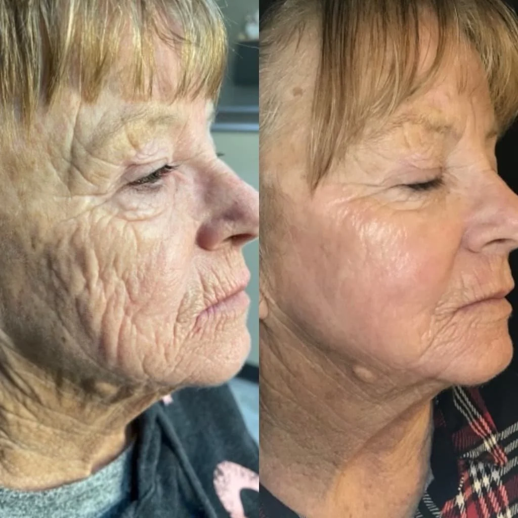 co2 pic Atomic derm (1).jpg