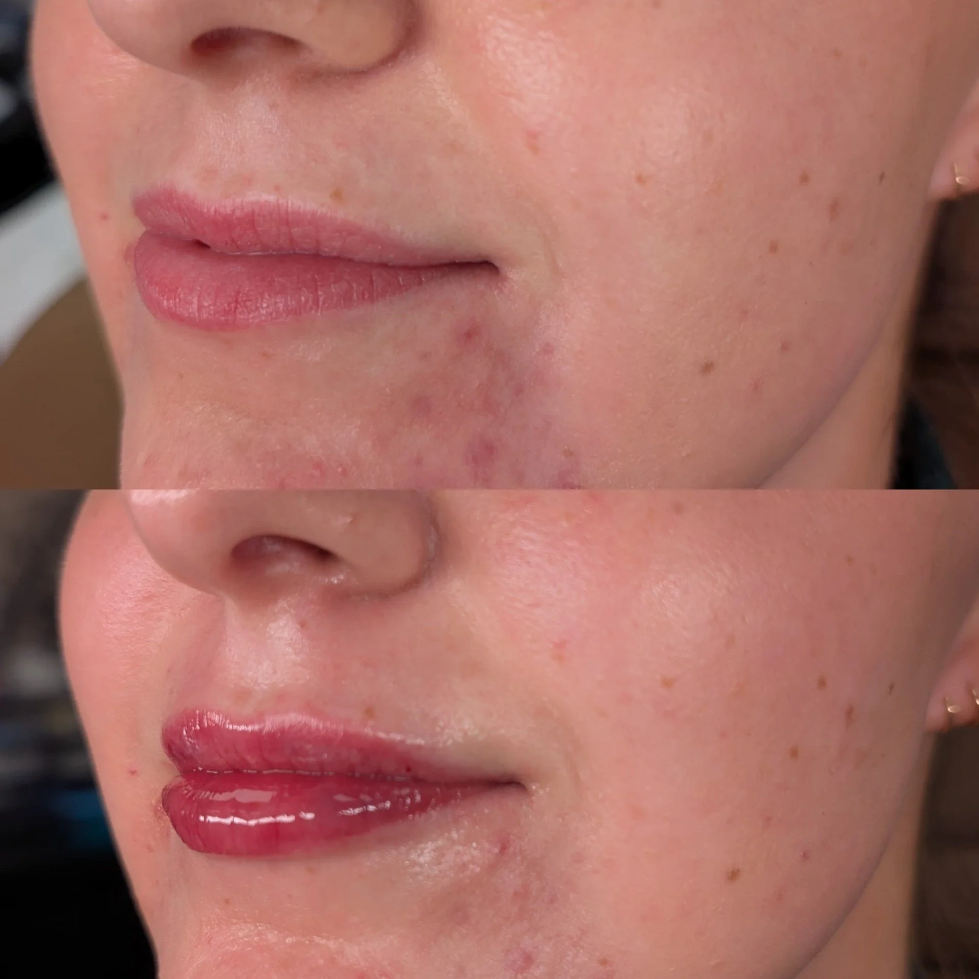 Lip filler before and after results at Bonato MD Aesthetics in Medford, OR
