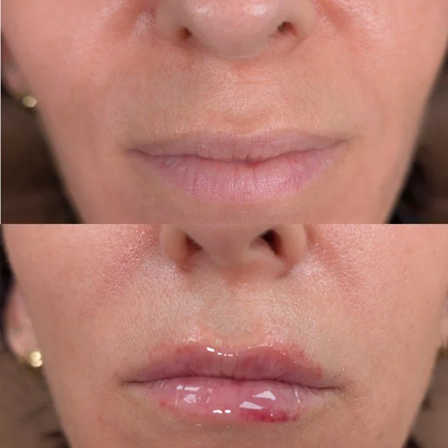 Lip filler before and after results at Bonato MD Aesthetics in Medford, OR