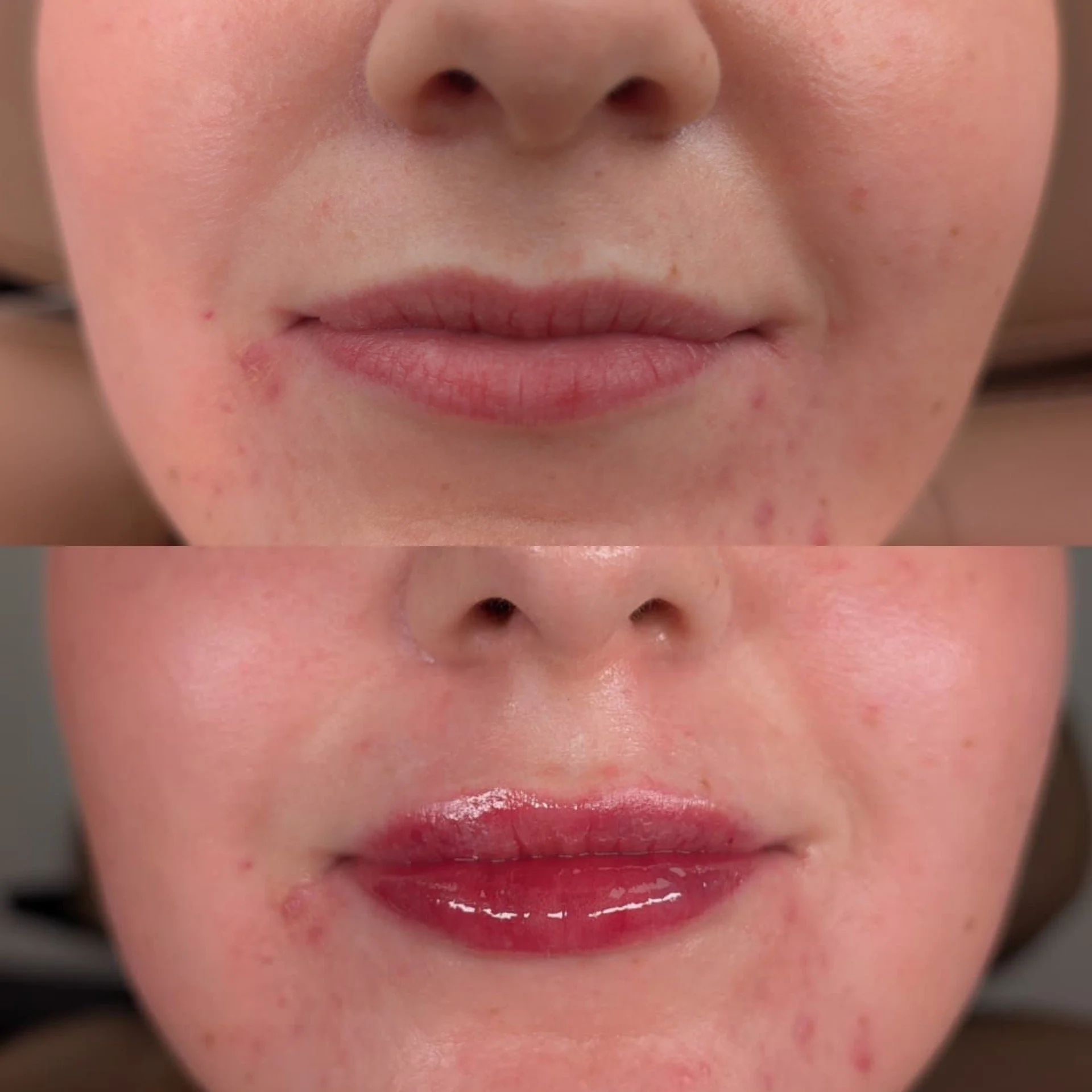 Lip filler before and after results at Bonato MD Aesthetics in Medford, OR
