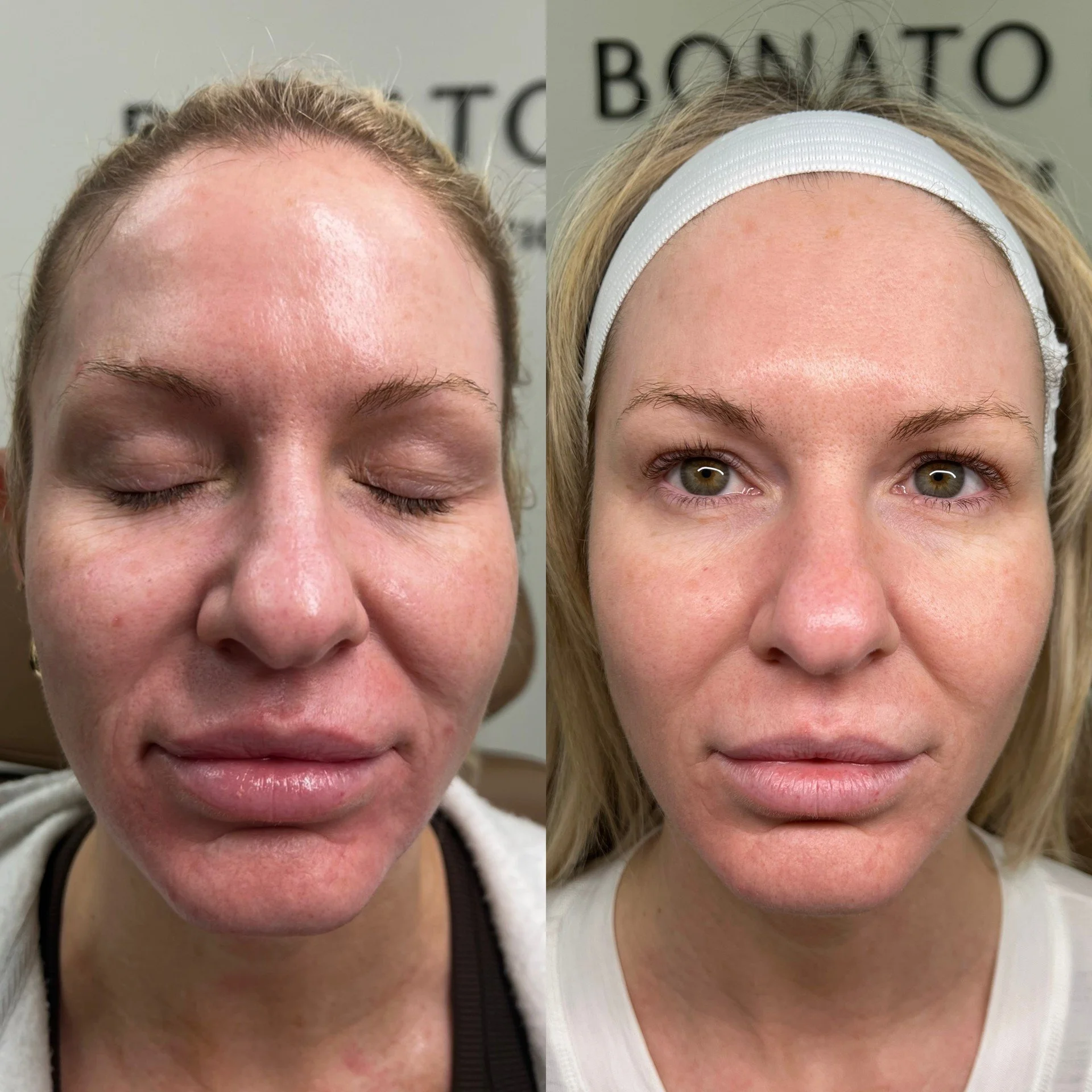 NOUVADerm laser skin rejuvenation before and after at Bonato MD Aesthetics in Medford, OR