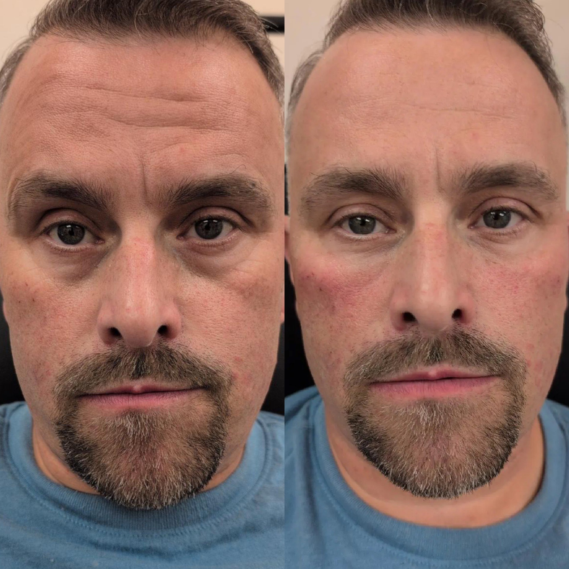 Cellenis Derma PRP gel filler before and after at Bonato MD Aesthetics in Medford, OR