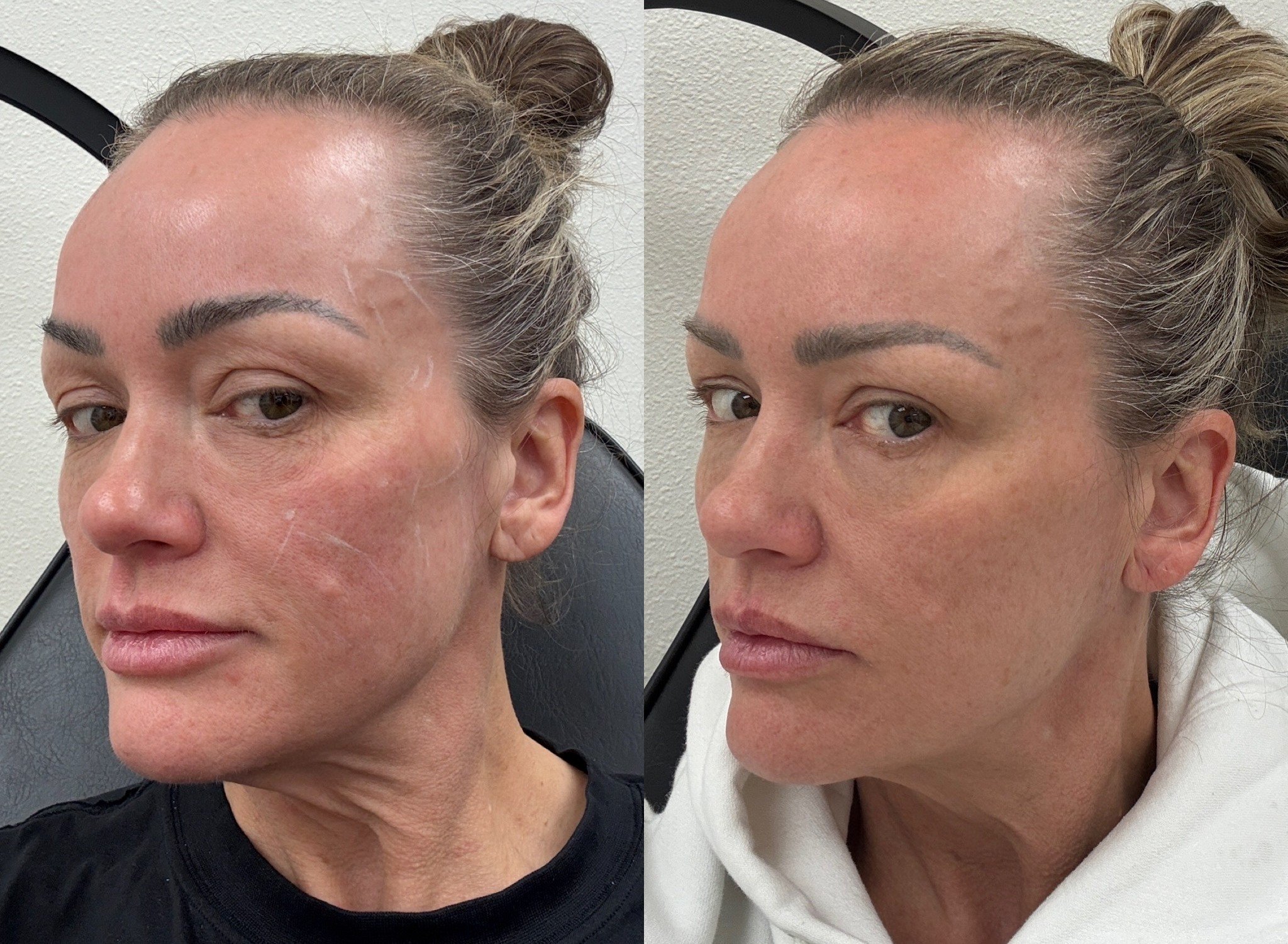 Sculptra biostimulator before and after results at Bonato MD Aesthetics in Medford, OR