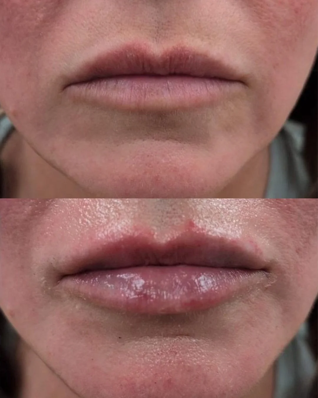 Lip filler before and after results at Bonato MD Aesthetics in Medford, OR