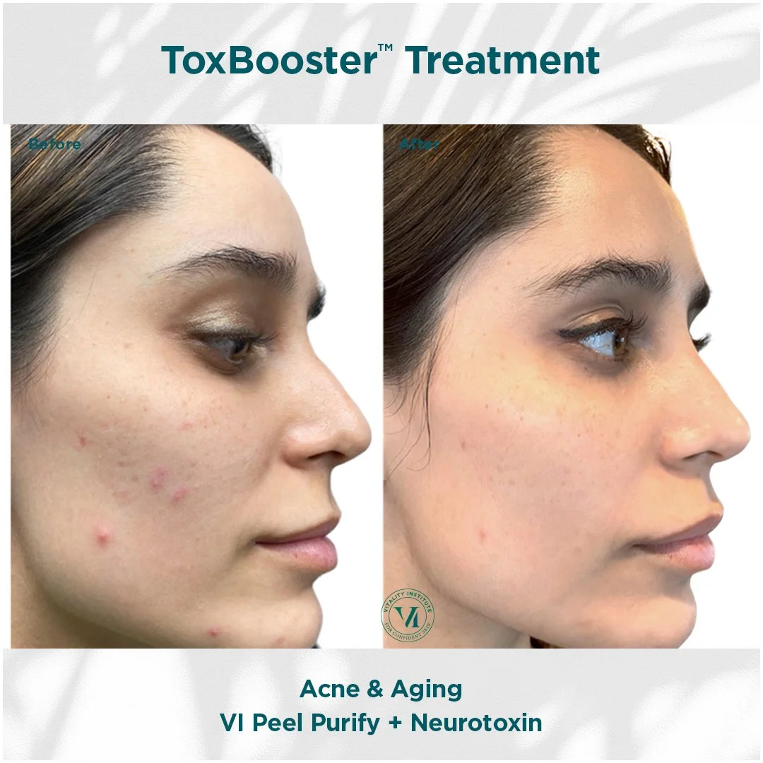 VI Peel chemical peel before and after at Bonato MD Aesthetics in Medford, OR