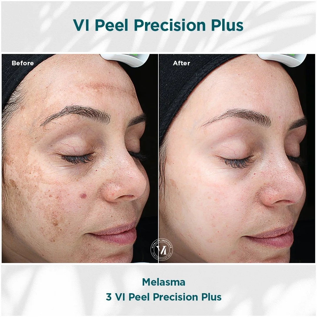 VI Peel chemical peel before and after at Bonato MD Aesthetics in Medford, OR