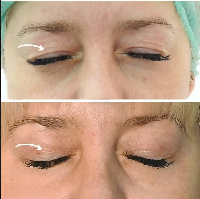 PLEXR Plus non-surgical eyelid lift before and after — Bonato MD Aesthetics