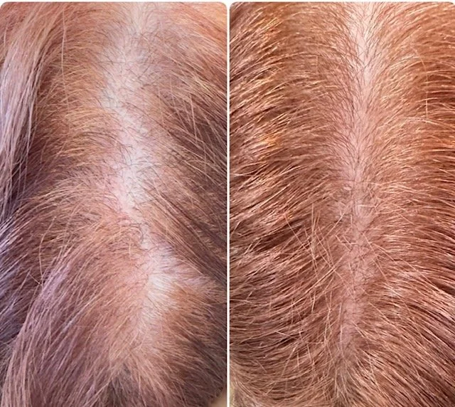 PRP hair restoration before and after results at Bonato MD Aesthetics in Medford, OR