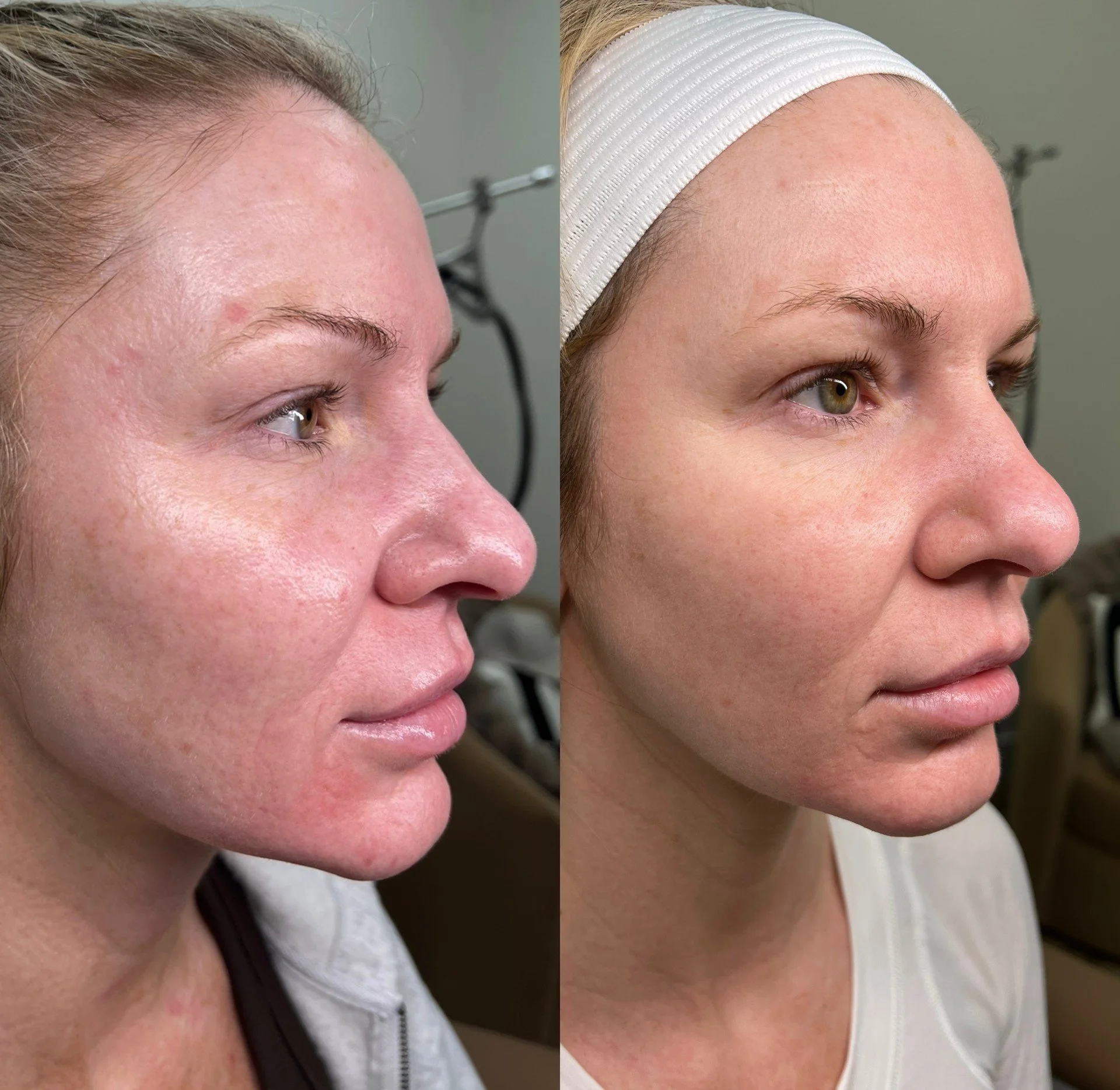 NOUVADerm laser skin rejuvenation before and after at Bonato MD Aesthetics in Medford, OR