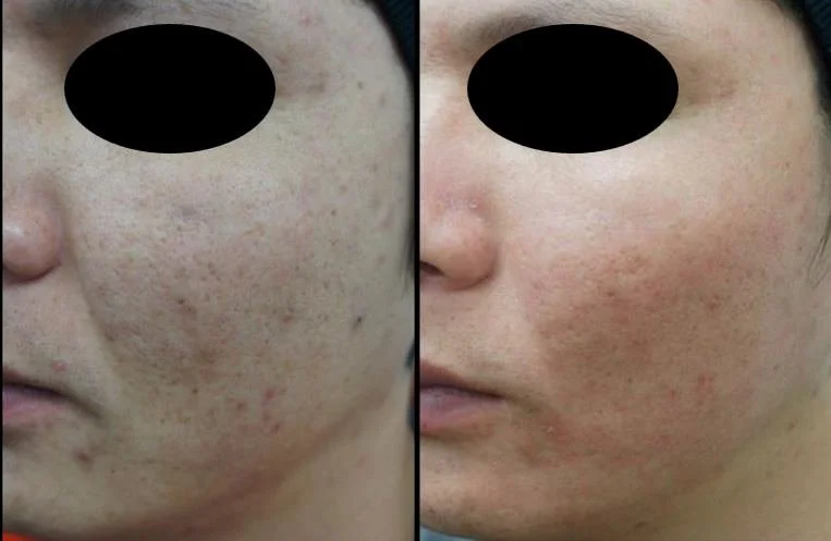 Manufacturer-supplied NOUVADerm before-and-after example. Treatment performed by another provider. Individual results vary.