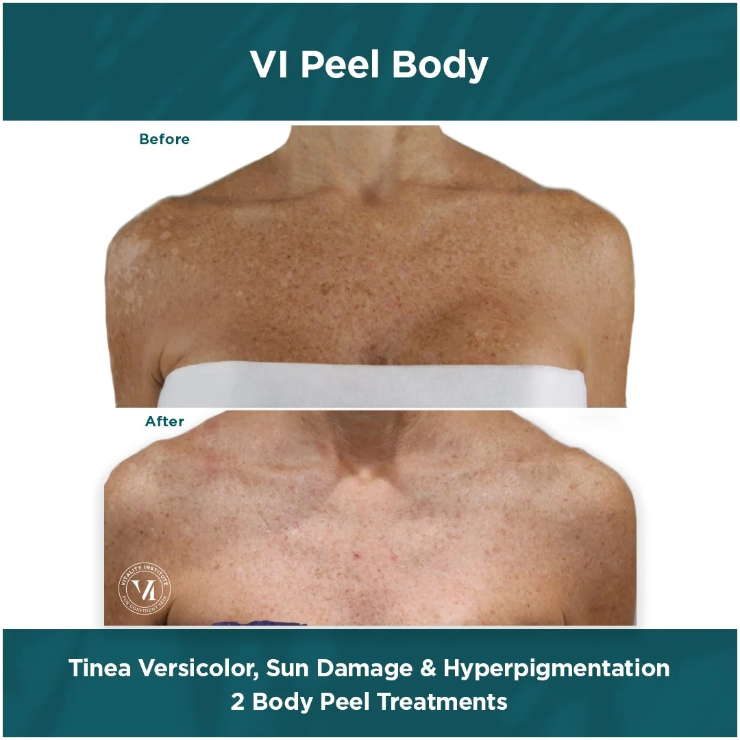 VI Peel chemical peel before and after at Bonato MD Aesthetics in Medford, OR