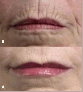 PLEXR Plus non-surgical peri-oral line correction before and after — Bonato MD Aesthetics