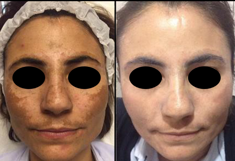 NOUVADerm laser skin rejuvenation before and after at Bonato MD Aesthetics in Medford, OR