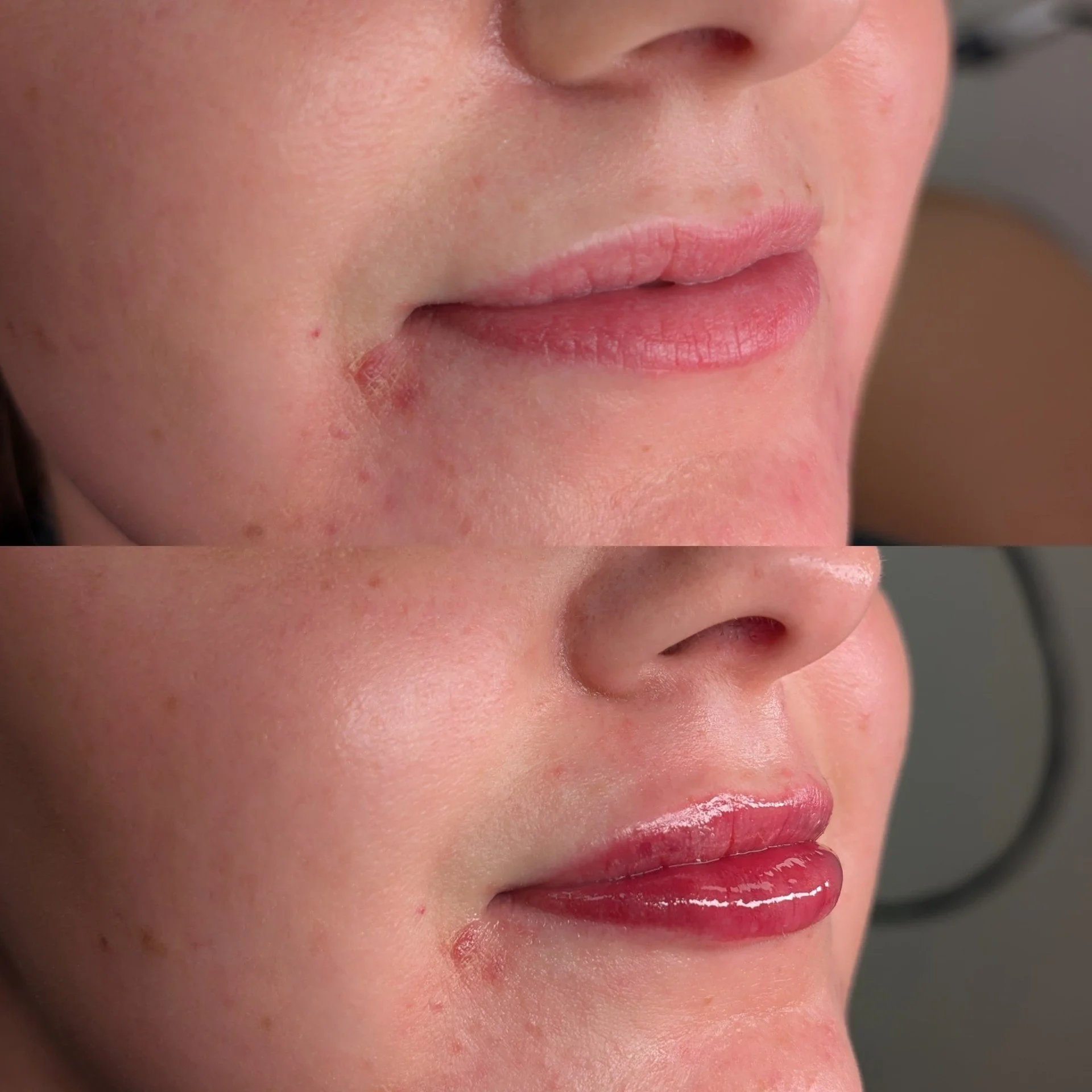 Lip filler before and after results at Bonato MD Aesthetics in Medford, OR