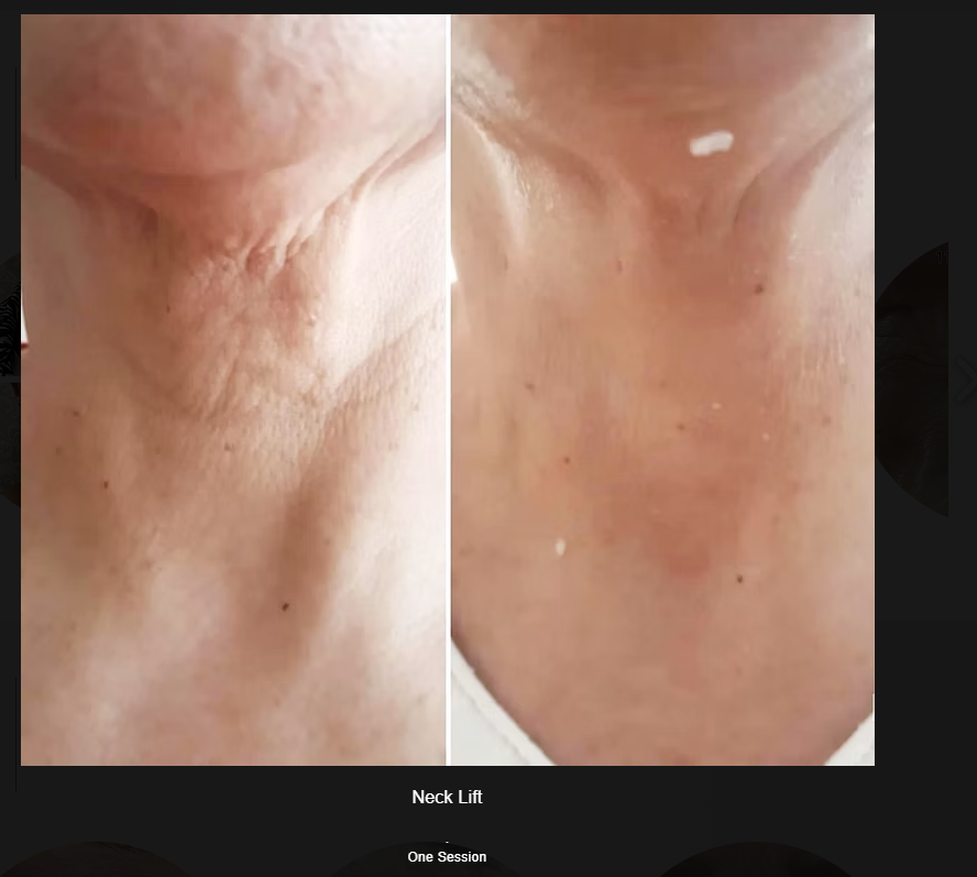 PLEXR Plus non-surgical neck lift before and after — Bonato MD Aesthetics