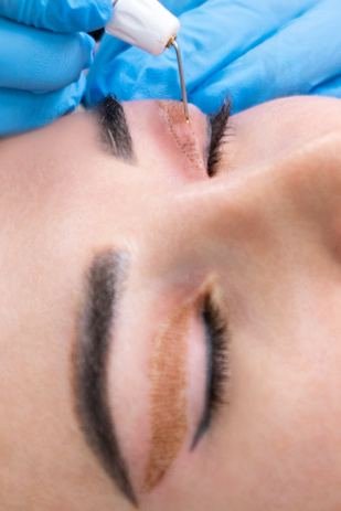 Provider in blue gloves using a fine device on a woman's upper eyelid