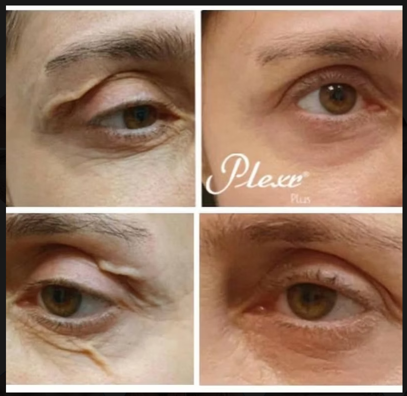 PLEXR Plus non-surgical eyelid lift before and after — Bonato MD Aesthetics