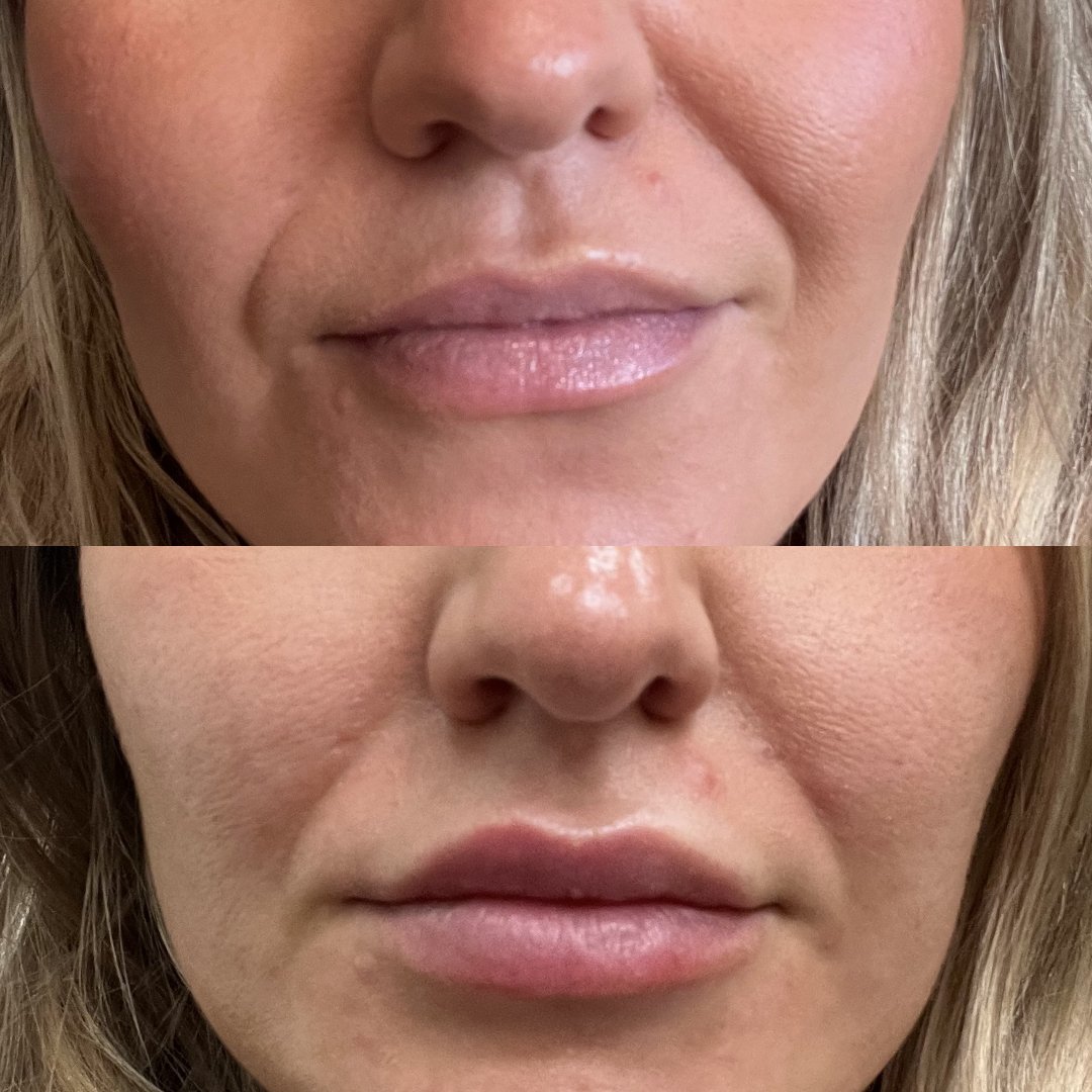 Lip filler before and after results at Bonato MD Aesthetics in Medford, OR