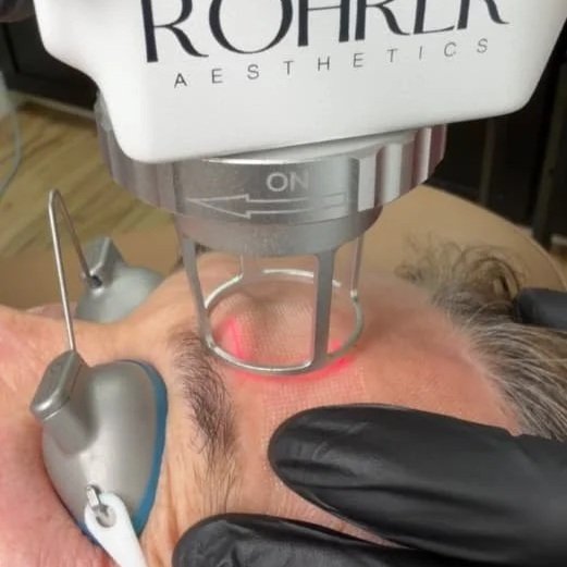 co2-laser-skin-resurfacing