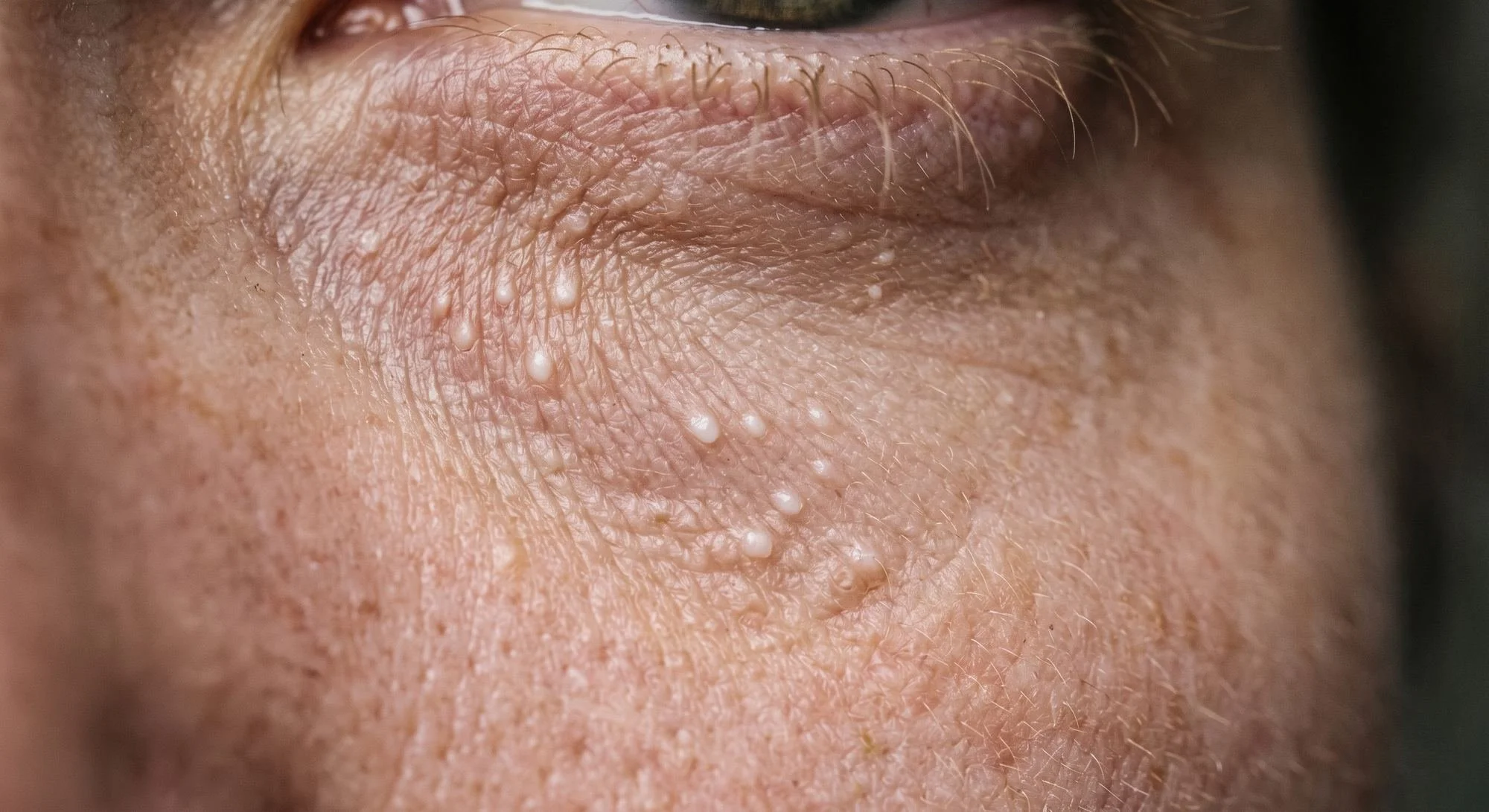 Close-up of small white milia bumps on the skin under an eye