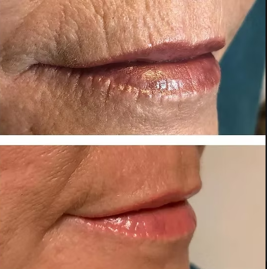 PLEXR Plus non-surgical peri-oral line correction before and after — Bonato MD Aesthetics