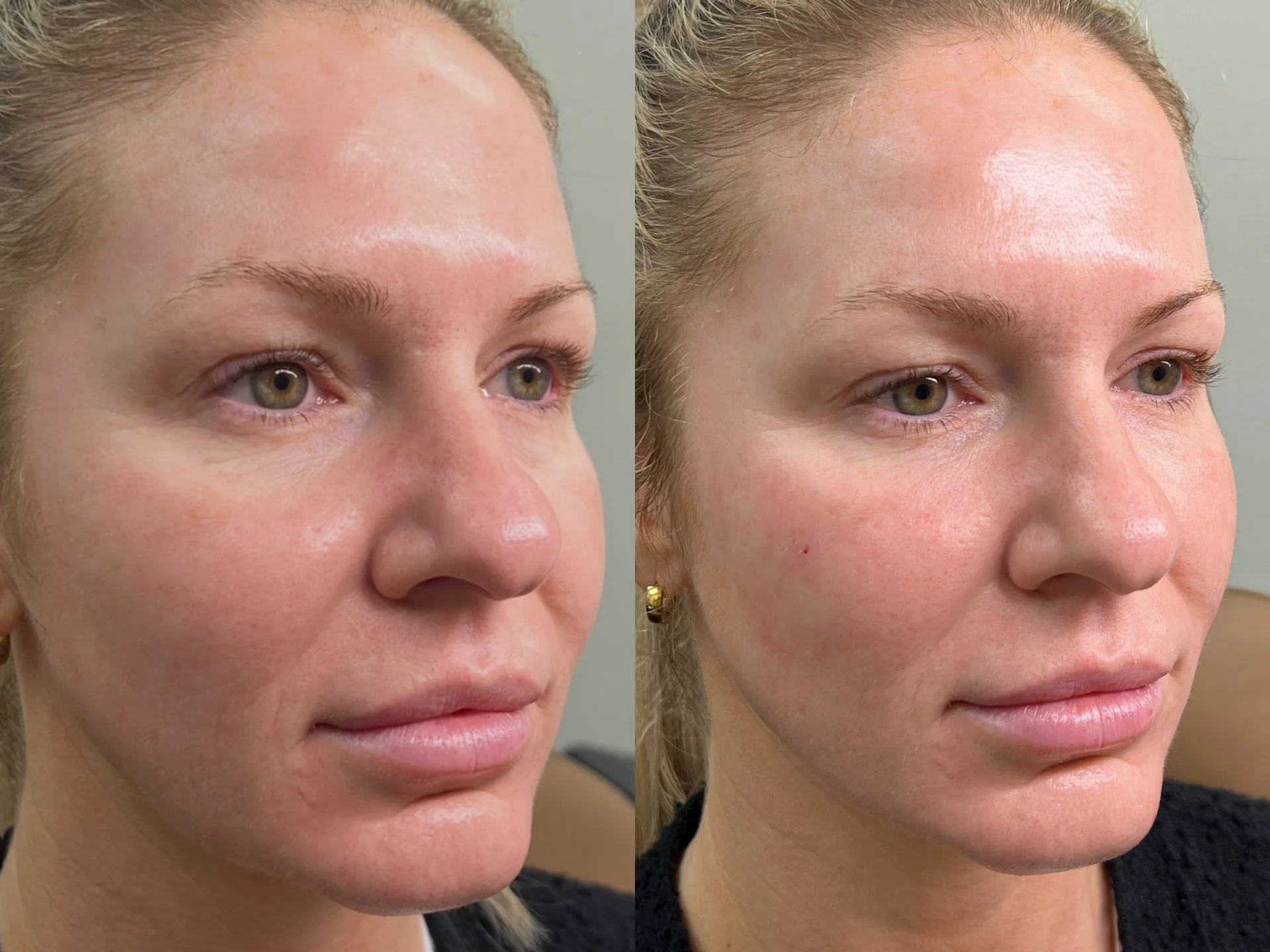 PRP Gel Filler
