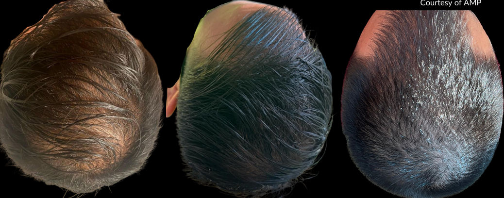 PRP hair restoration before and after results at Bonato MD Aesthetics in Medford, OR