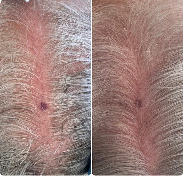 PRP hair restoration before and after results at Bonato MD Aesthetics in Medford, OR